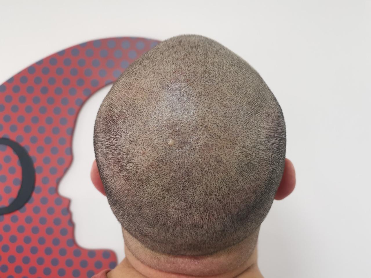 Resultado micropigmentación