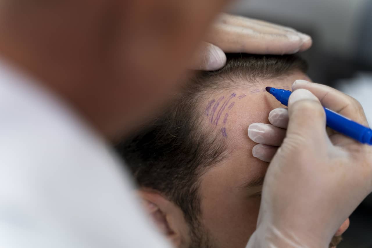 Implante de Barba